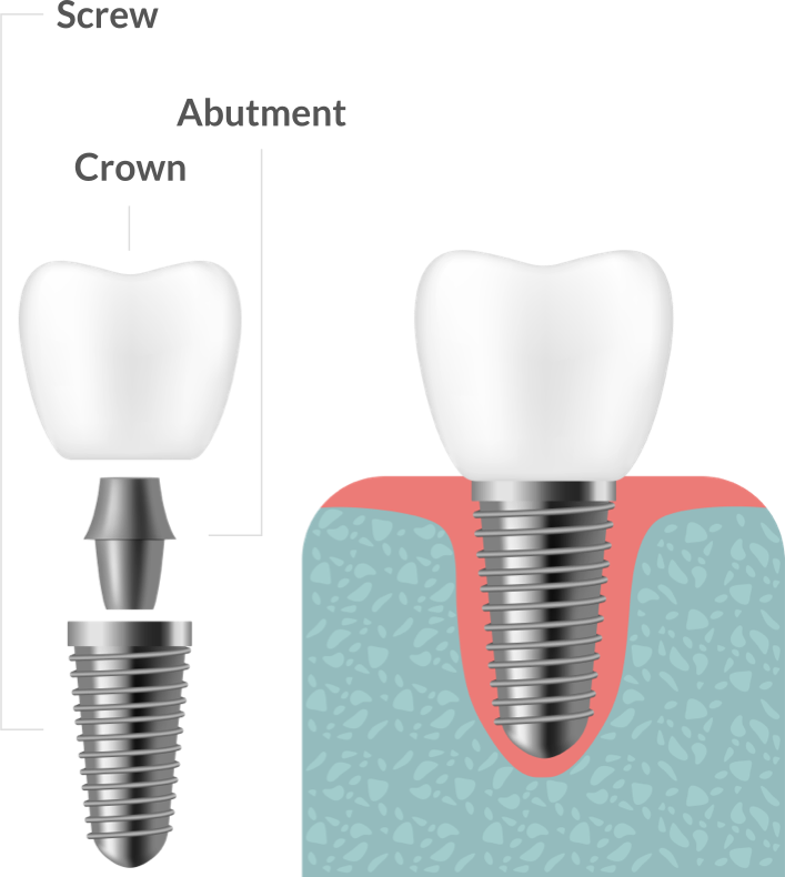 mobile-implant