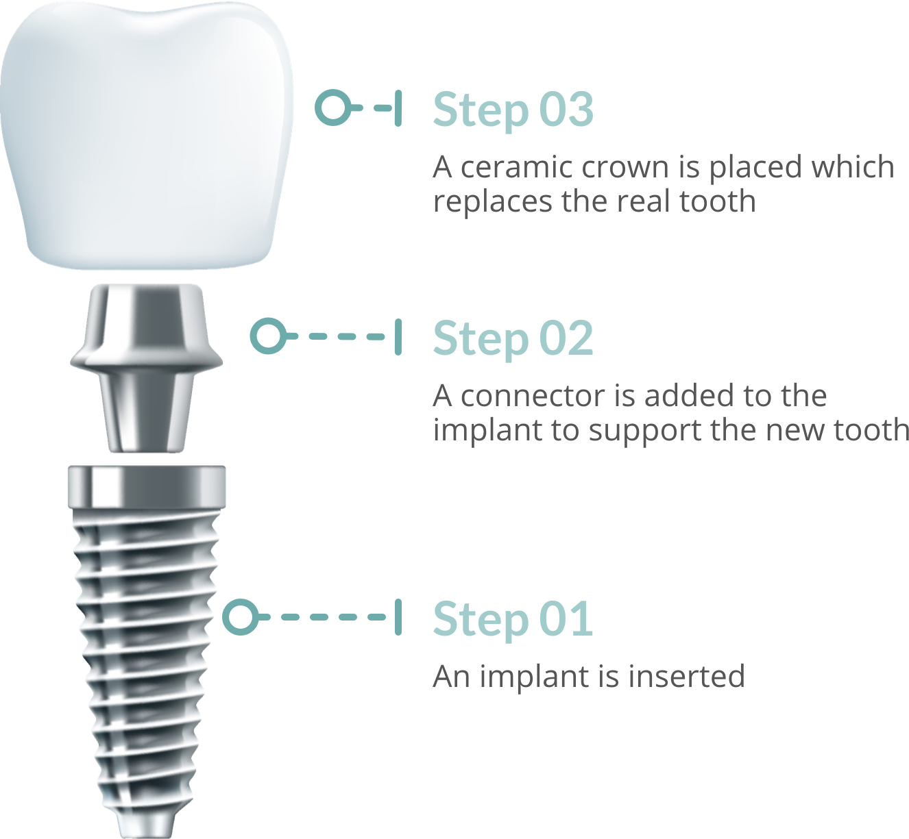 detal-implant-steps